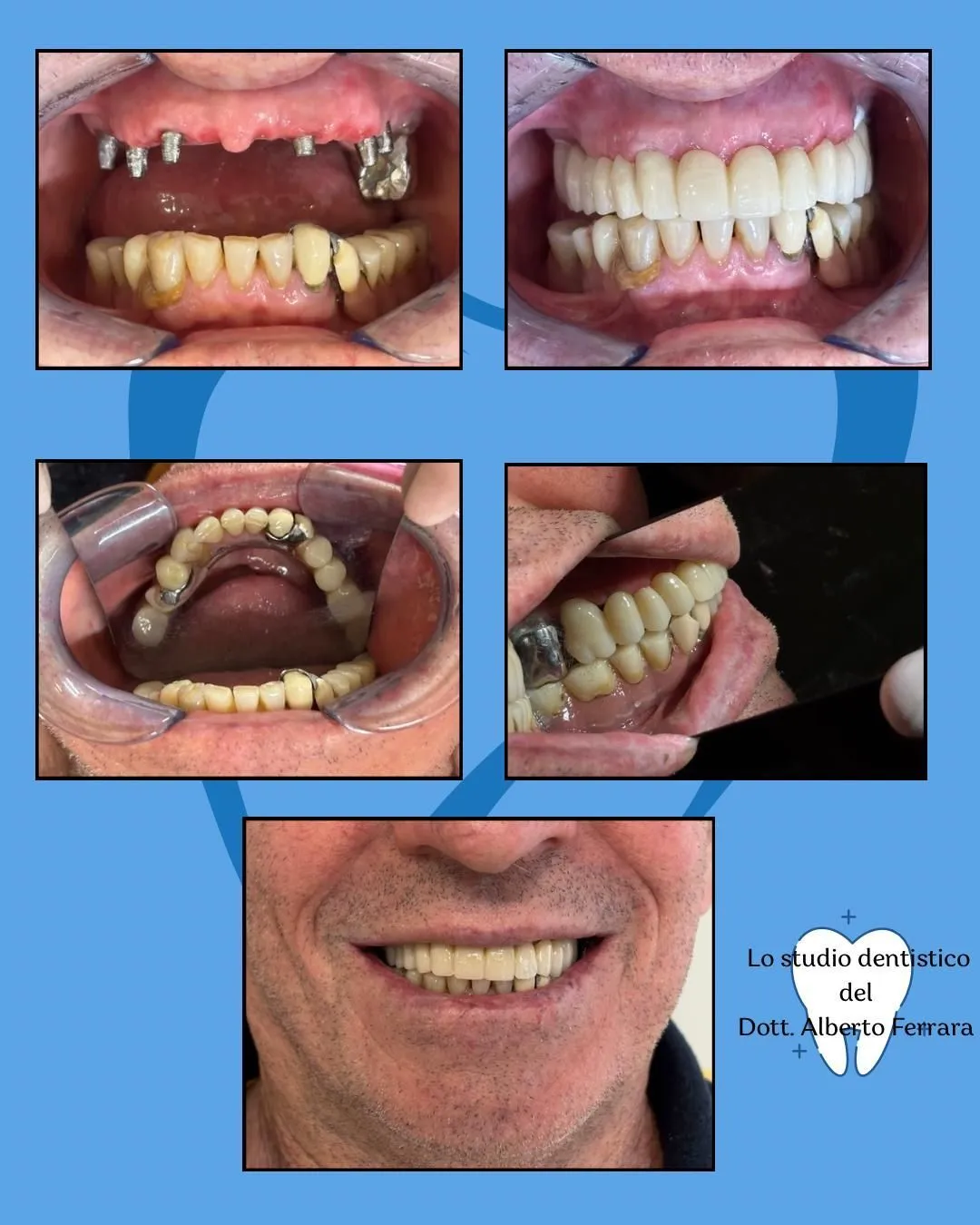 Esempio di lavoro odontoiatrico - trattamento 1