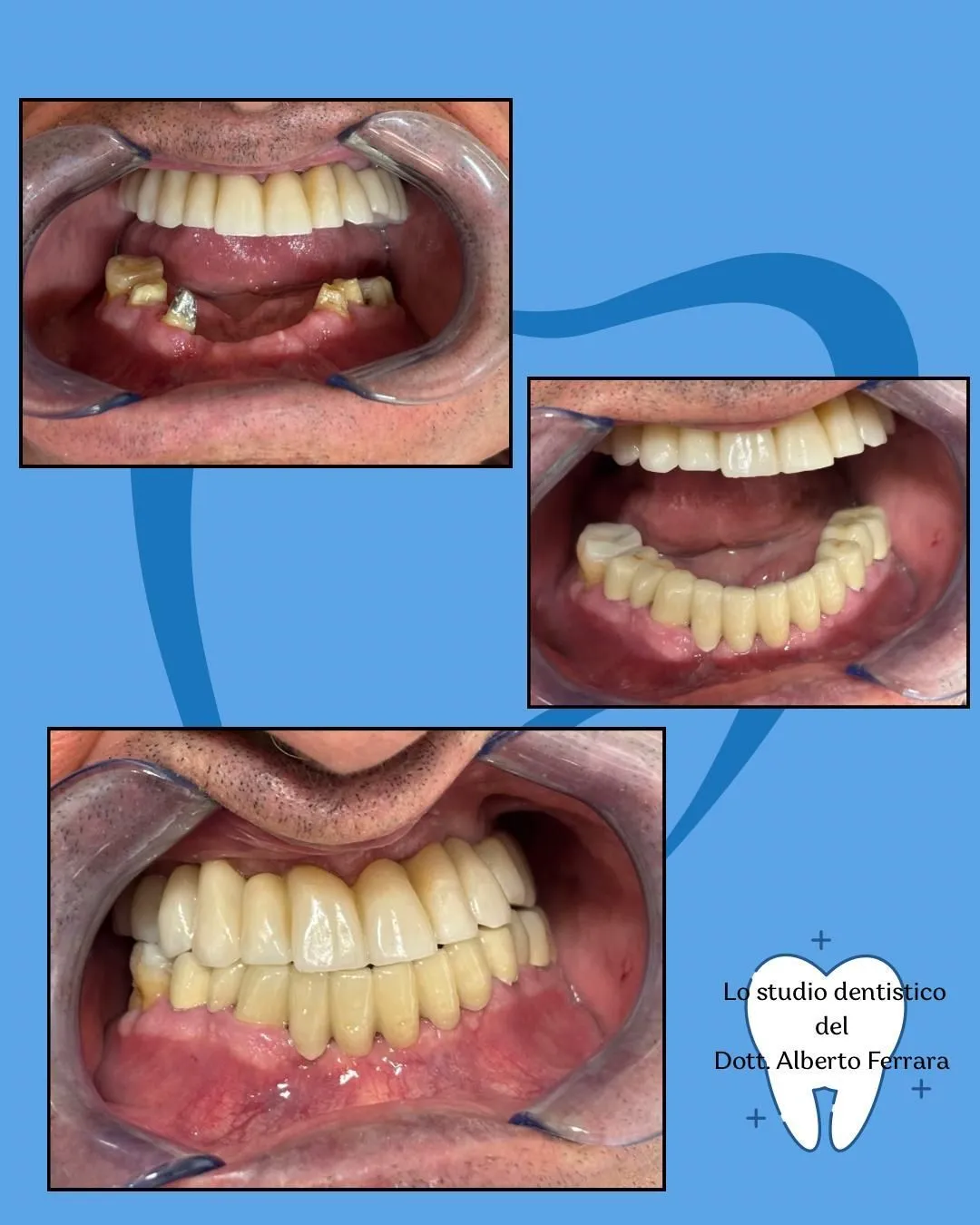 Esempio di lavoro odontoiatrico - trattamento 2