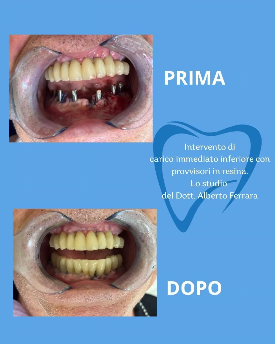 Esempio di lavoro odontoiatrico - trattamento 3