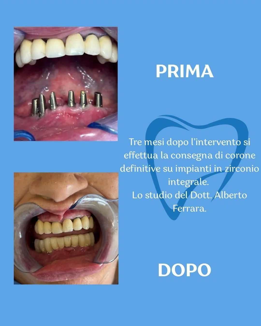 Esempio di lavoro odontoiatrico - trattamento 4